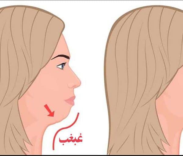 ساکشن غبغب