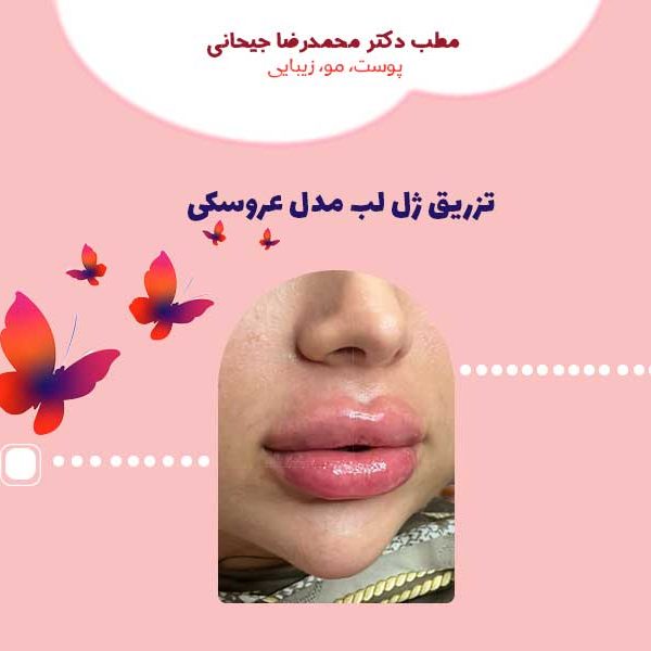 ژل لب عروسکی