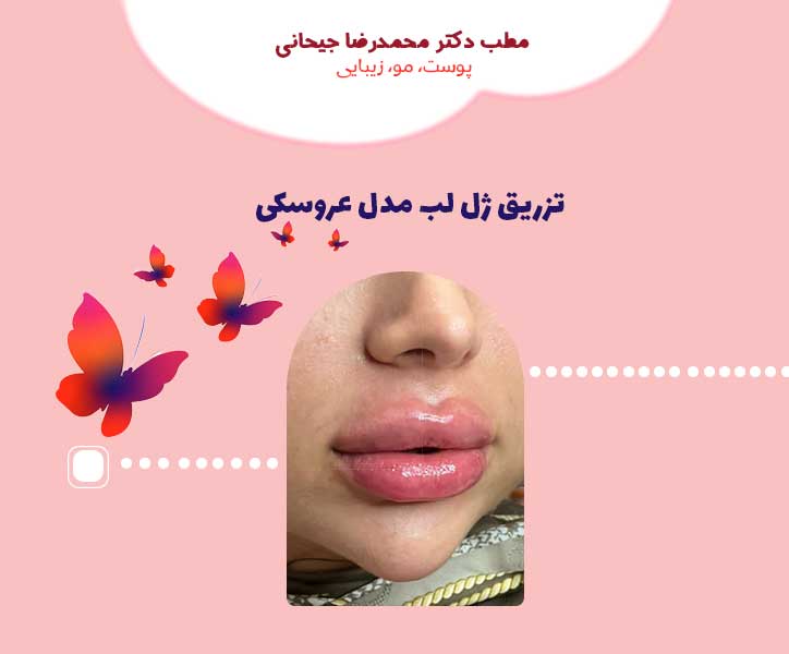 ژل لب عروسکی