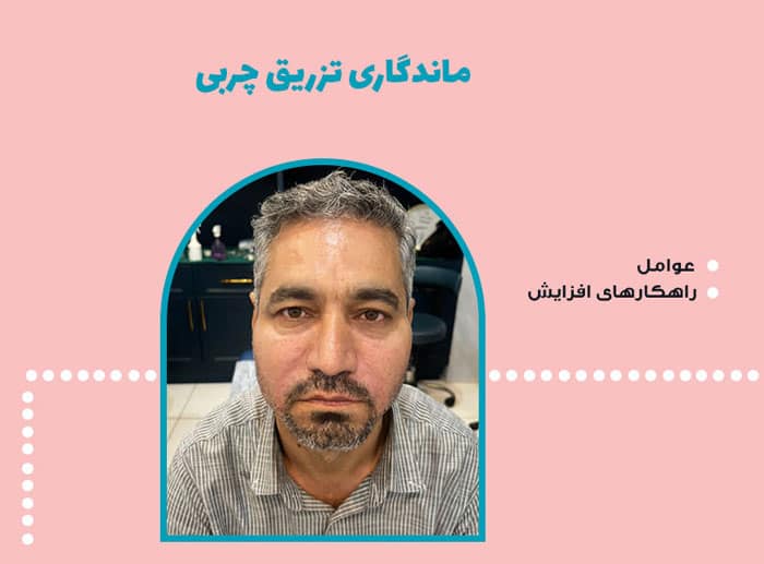 ماندگاری تزریق چربی