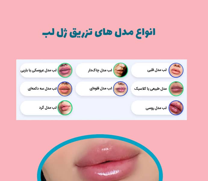 انواع مدل های تزریق ژل لب