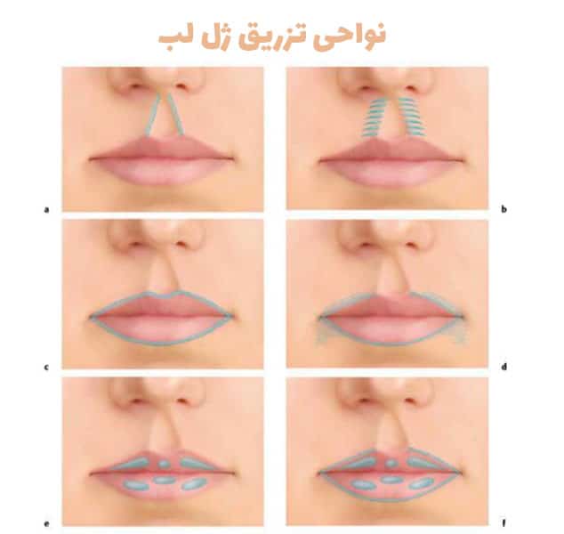 نواحی تزریق ژل لب