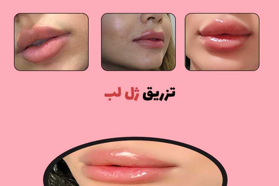 تزریق ژل لب