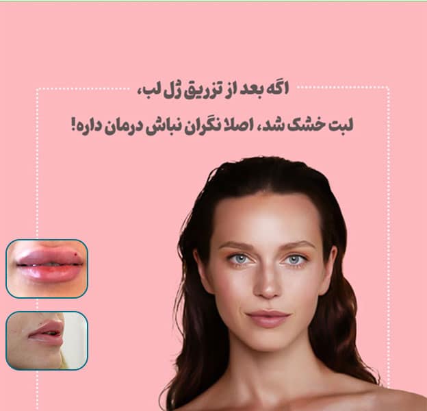 عوارض تزریق ژل لب