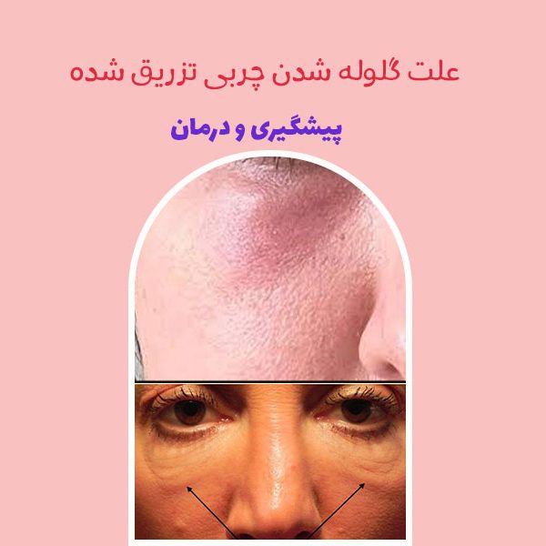 علت گلوله شدن چربی تزریق شده