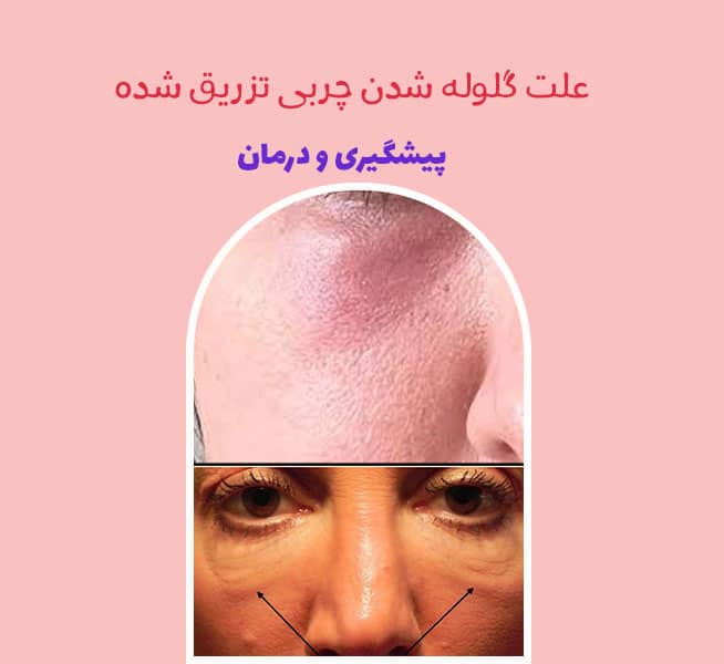 علت گلوله شدن چربی تزریق شده