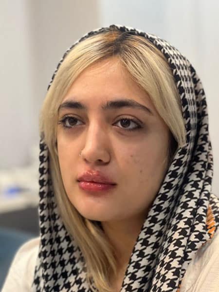 after بعد از تزریق ژل