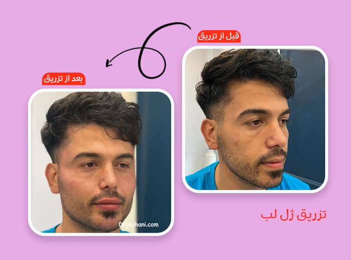تزریق چربی