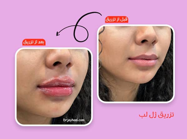 تزریق ژل لب عروسکی