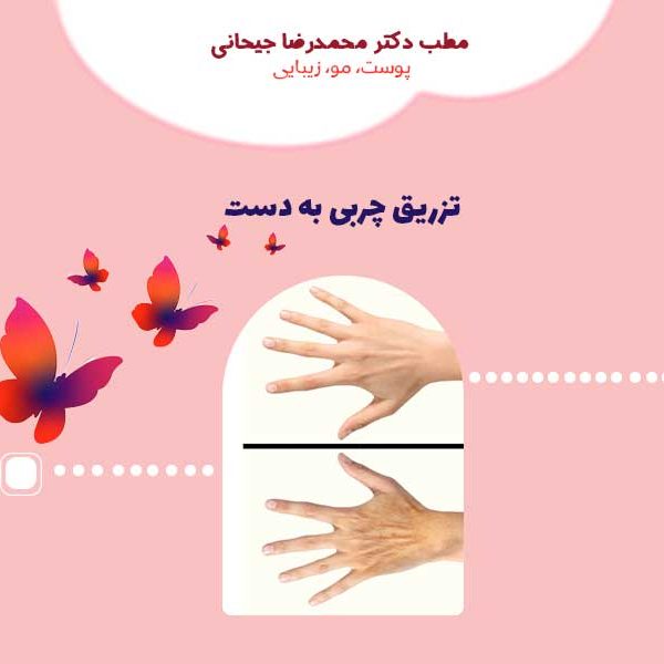 تزریق چربی به دست