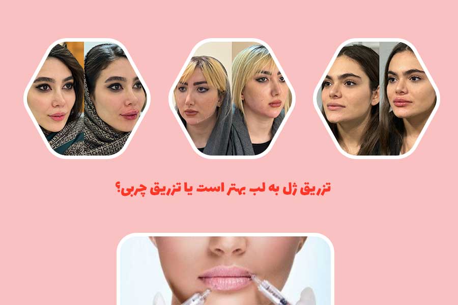 تزریق ژل به لب بهتر است یا تزریق چربی