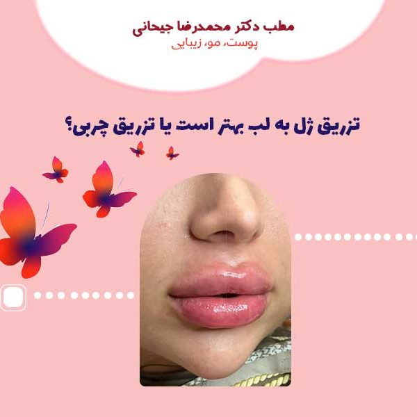 تزریق ژل به لب بهتر است یا تزریق چربی