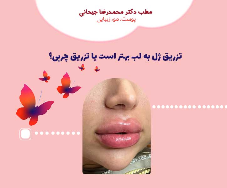 تزریق ژل به لب بهتر است یا تزریق چربی