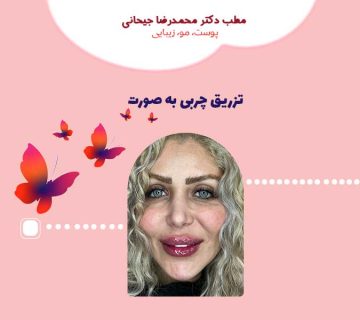 تزریق چربی به صورت