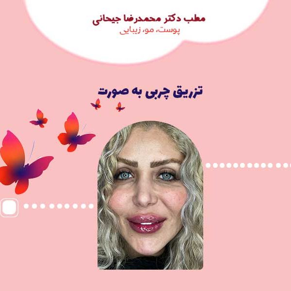تزریق چربی به صورت