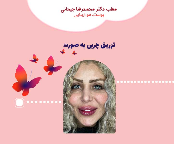 تزریق چربی به صورت