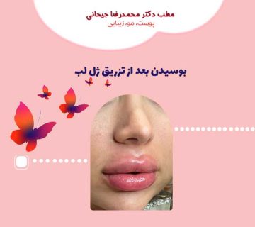 بوسیدن بعد از تزریق ژل لب