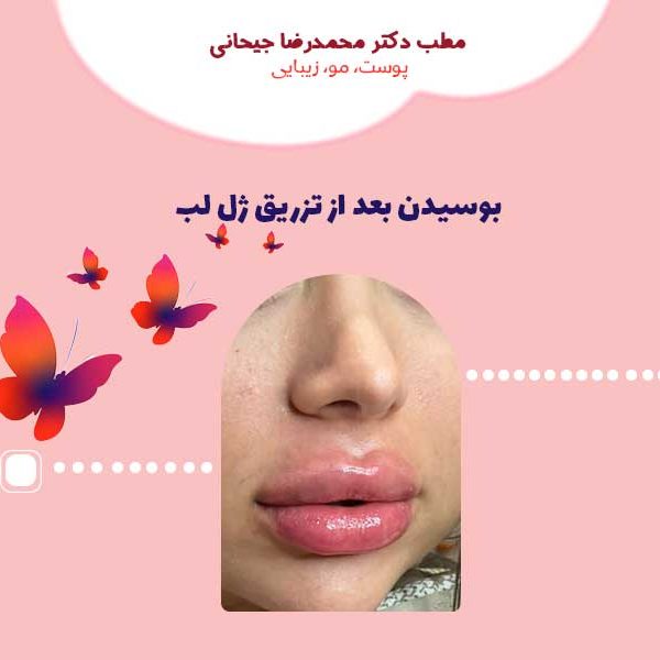 بوسیدن بعد از تزریق ژل لب