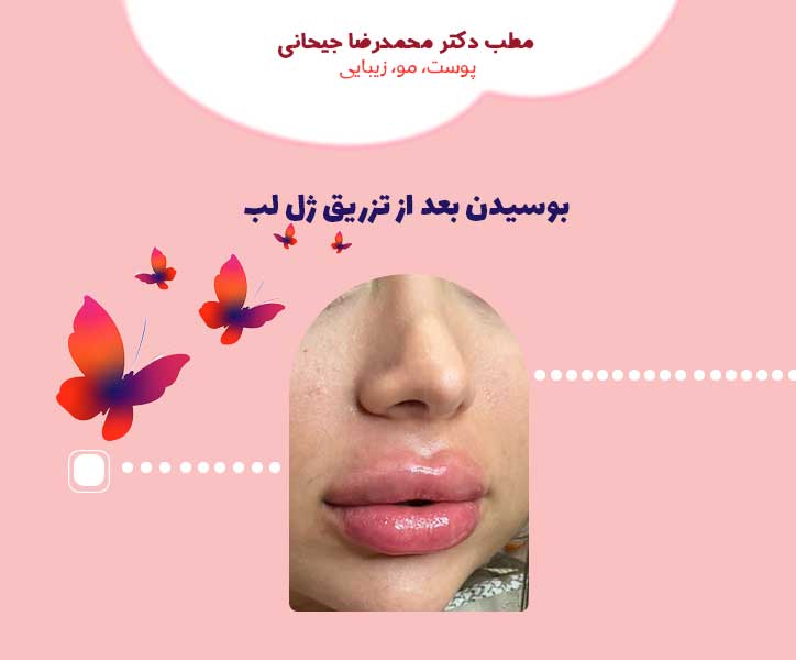 بوسیدن بعد از تزریق ژل لب